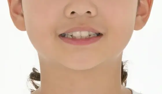 공간 부족 · 악궁 확장 사례 01(악궁 확장) 치료 전 얼굴 정면 사진