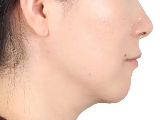 무턱 교정 사례 01(비수술 교정) 치료 후 얼굴 옆모습 사진 – 턱끝 인상 개선, 치료기간 24개월
