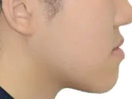 주걱턱 (비수술) 사례 03(비수술 교정) 치료 전 얼굴 옆모습 사진